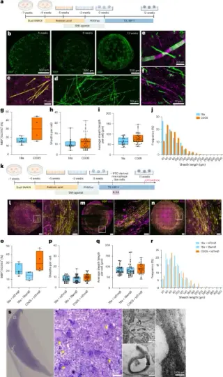 Human Stem Cell Model Mimics Multiple Sclerosis Myelin Damage and Repair