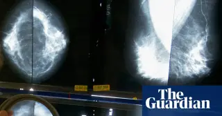 Genomic test could spare millions of breast cancer patients from chemotherapy