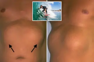 UC Irvine Study Identifies 'Liposurfomas' as Benign Chest Growths in Longtime Surfers