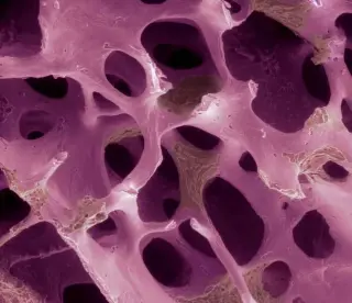 Cell Therapy Trial Shows 94% Drop in Osteoporosis Fractures