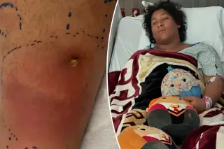 Florida teen fights for life after flesh-eating bacteria from park swim