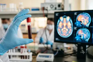 A Decade Ahead: Blood Marker Flags Alzheimer’s Risk, But No Cure Yet