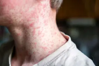 Kentucky county on alert as measles case raises outbreak fears