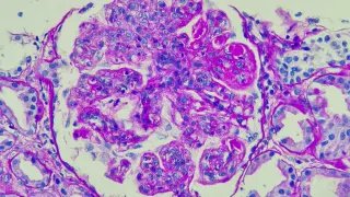 New CAR-T dawn for autoimmune disease: lupus case fuels research and investment