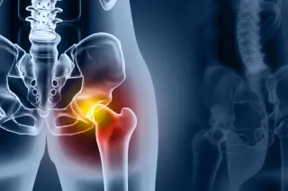 Modern Hip Replacements Deliver Decades of Movement, Study Finds