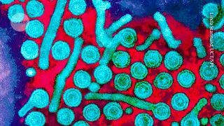 Epigenetic Therapy Silences Hepatitis B Virus in Early Trials