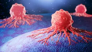 Novel human antibody stalls spread of aggressive prostate cancer in preclinical study