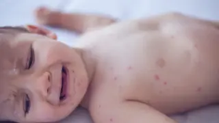 Pennsylvania Measles Crisis Escalates with Rare Congenital Cases and CDC Intervention
