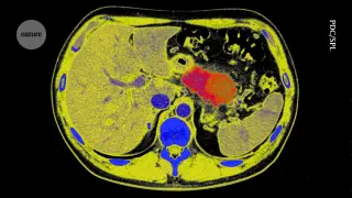Early Detection and New RAS Inhibitors Aim to Triple Pancreatic Cancer Survival