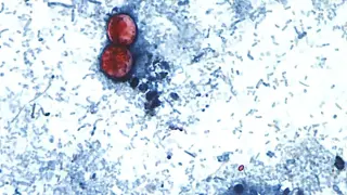 Minnesota Remains Out of Nationwide Cyclospora Outbreak, Health Officials Report