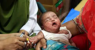 Bangladesh Measles Crisis: 1,200 Deaths and 214,000 Cases Expose Global Vaccination Failures