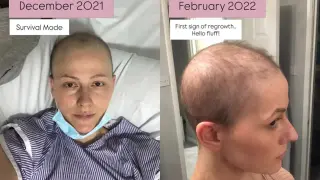 From Shaved Head to Chemo Curls: A Survivor’s Hair Regrowth Story