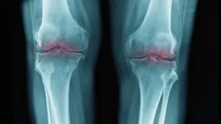 Aging Joint Breakthrough: Blocking 15-PGDH Rebuilds Cartilage
