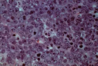 Off-the-shelf CAR-T shows potential to delay lymphoma relapse in interim Phase 3 results