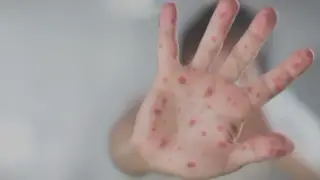 PA Health Officials Warn of Measles Exposure at Lebanon County Target