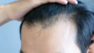 New Study Flags Hair Loss Risk with GLP-1 Drugs