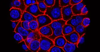 Georgia hospitals launch trials of a promising pancreatic cancer drug