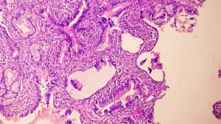 PSA Alone Can Miss Prostate Cancer Growth; Regular Imaging Urged