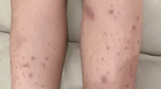 Pediatric IgA Vasculitis Case Highlights Delayed Diagnosis After Initial Isolated Purpura
