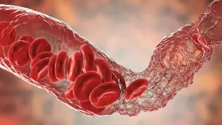 Molecular trigger found for rare vaccine-induced blood clots