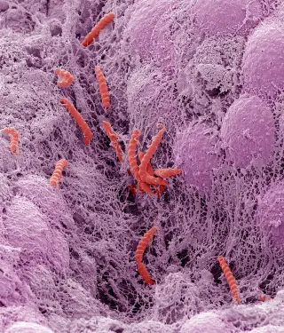 Infections Account for 12% of Global Cancers, Study Finds