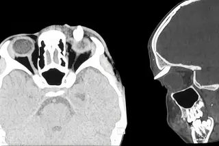 Indian teen becomes first known patient with tooth growing in upper eye socket