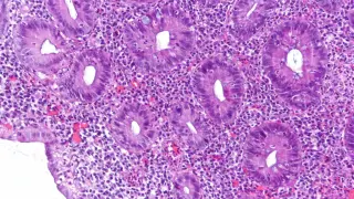 Abivax UC drug delivers strong remission in Phase 3, but safety signals spark caution