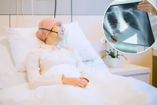 Rare Genetic Mutation Identified as Major Lung Cancer Risk Factor for Non-Smokers