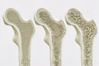 GPR133 Receptor Emerges as a New Target to Strengthen Bones
