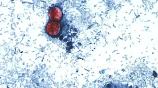 Cyclosporiasis outbreak expands to nine states linked to Mexican iceberg lettuce