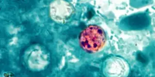 Hawaii reports fifth cyclosporiasis case of 2026 amid ongoing outbreak checks