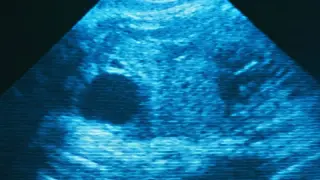 Spike in ectopic-pregnancy deaths linked to abortion bans