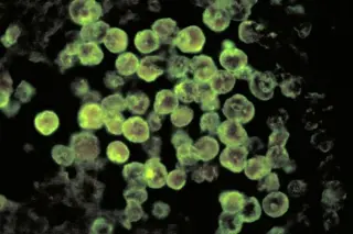 North Carolina teen fights for life after rare brain-eating amoeba infection