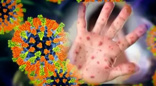Measles exposure at Rochester hospital spurs public health alert
