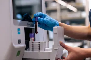Lp(a) test reveals a hidden heart-health risk beyond routine cholesterol checks