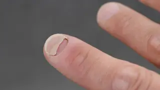 GLP-1 Users Report Fourfold Increase in Nail Detachment, Study Finds