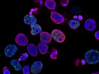 First human trial tests partial reprogramming to reverse aging in glaucoma
