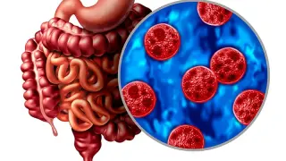 Sulfa Labels Hamper Cyclospora Treatment in Outbreak