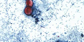 Tennessee Faces Major Cyclosporiasis Outbreaks Tied to Travel