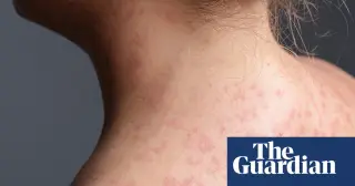 Six California counties issue measles exposure alert tied to unvaccinated traveler
