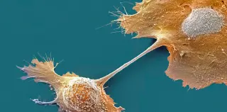 First-in-class KRAS therapy boosts survival in metastatic pancreatic cancer