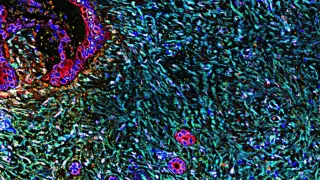 Daraxonrasib Poised to Redefine Second-Line Pancreatic Cancer Care