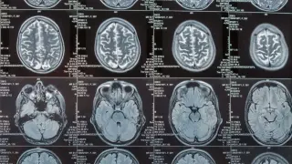 Peripheral Immune Signals Drive Alzheimer's Brain Damage, Study Finds