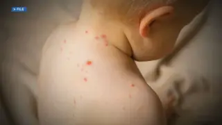 Measles surge in Oregon tests herd immunity as vaccines decline