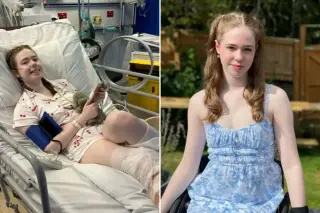 CRPS patient chooses leg amputation to reclaim life from constant pain