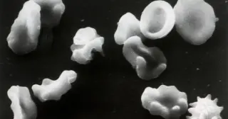 Gene Therapy Breakthrough Brings Hope to Black Americans Living With Sickle Cell