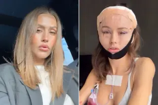 Cosmetic-Surgery Swelling Leaves Influencer Unrecognizable to Her iPhone