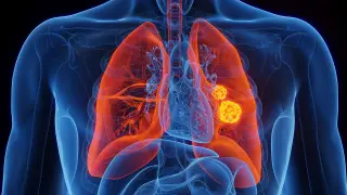 Inherited EGFR mutation sharply elevates lung cancer risk in nonsmokers