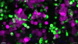 Edge-Guard Macrophages Attack Live Melanoma Cells, Poised to Boost Immunotherapy