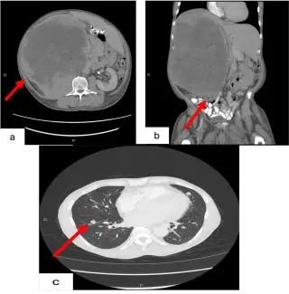 31-cm Papillary Renal Tumor Reported With Suspected Metastases